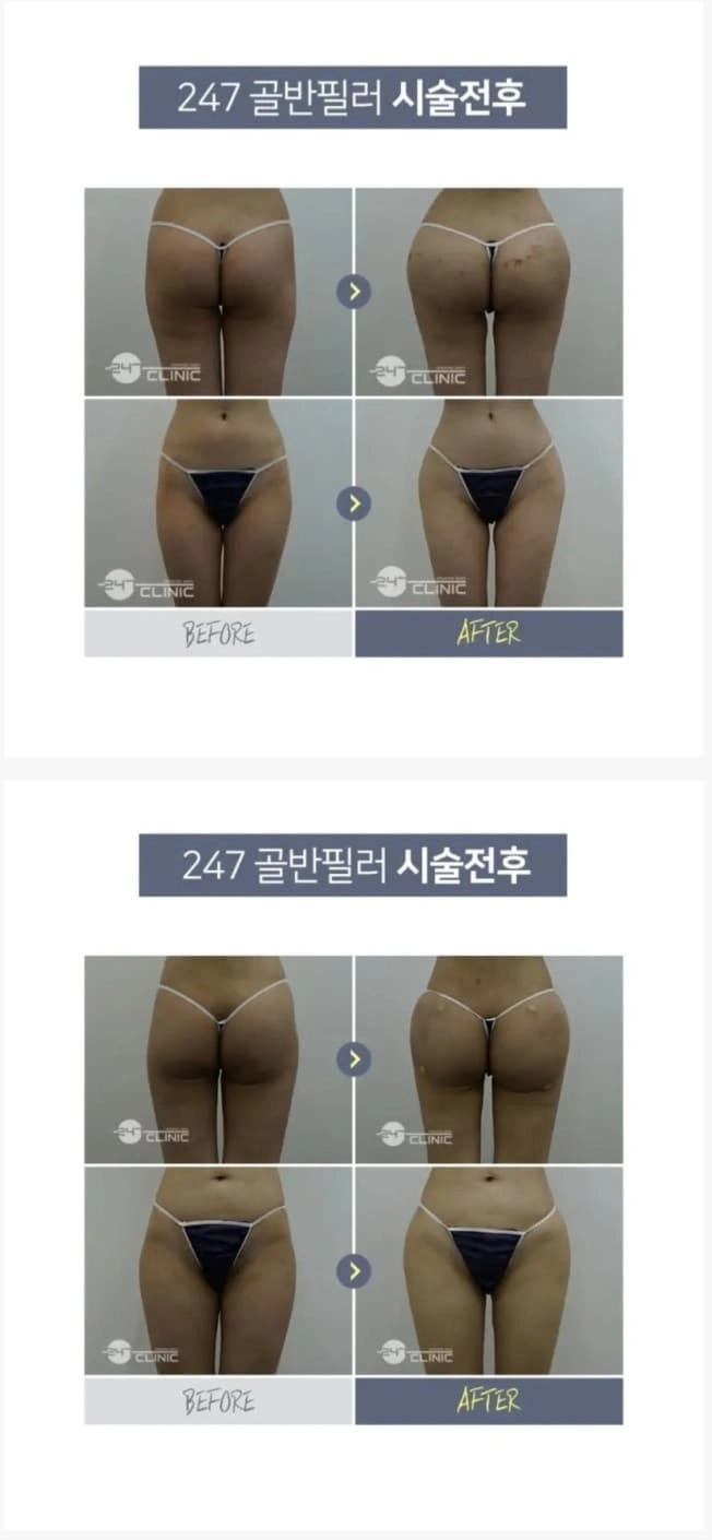 요즘 여자들 골반도 다 짭인 이유